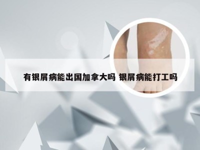 有银屑病能出国加拿大吗 银屑病能打工吗