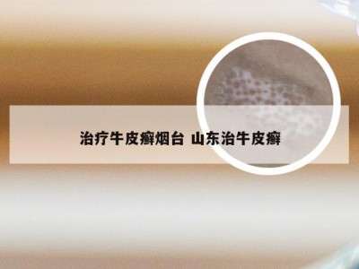 治疗牛皮癣烟台 山东治牛皮癣