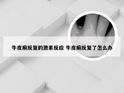 牛皮癣反复的激素反应 牛皮癣反复了怎么办
