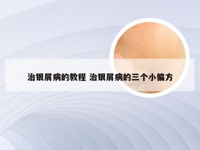 治银屑病的教程 治银屑病的三个小偏方