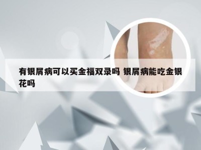 有银屑病可以买金福双录吗 银屑病能吃金银花吗