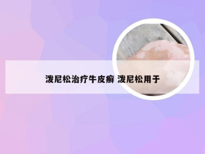 泼尼松治疗牛皮癣 泼尼松用于
