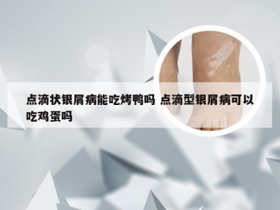 点滴状银屑病能吃烤鸭吗 点滴型银屑病可以吃鸡蛋吗