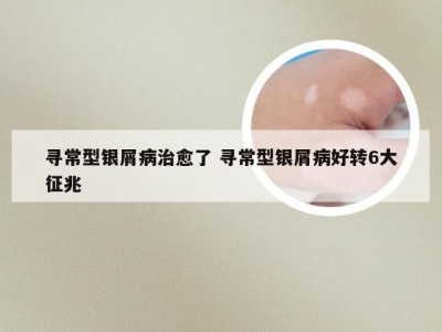 寻常型银屑病治愈了 寻常型银屑病好转6大征兆