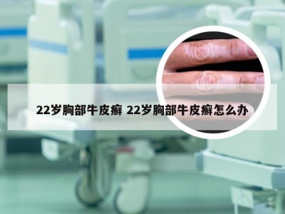 22岁胸部牛皮癣 22岁胸部牛皮癣怎么办