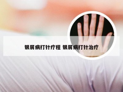 银屑病打针疗程 银屑病打针治疗