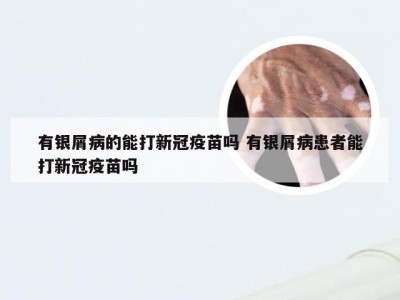 有银屑病的能打新冠疫苗吗 有银屑病患者能打新冠疫苗吗