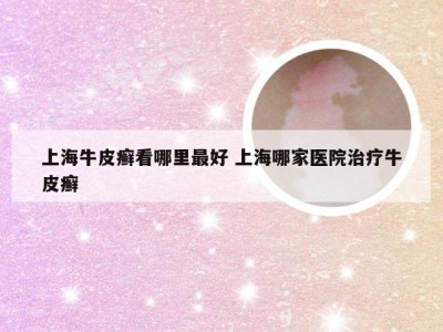 上海牛皮癣看哪里最好 上海哪家医院治疗牛皮癣