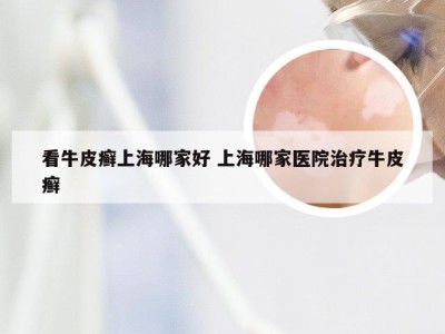 看牛皮癣上海哪家好 上海哪家医院治疗牛皮癣
