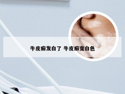 牛皮癣发白了 牛皮癣变白色
