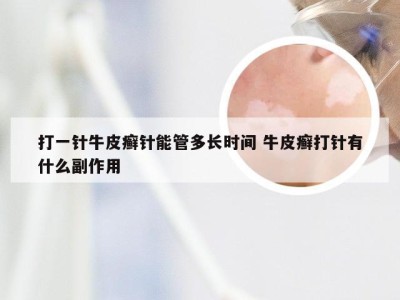 打一针牛皮癣针能管多长时间 牛皮癣打针有什么副作用
