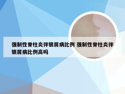 强制性脊柱炎伴银屑病比例 强制性脊柱炎伴银屑病比例高吗