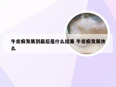 牛皮癣发展到最后是什么结果 牛皮癣发展快么