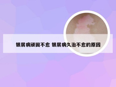 银屑病顽固不愈 银屑病久治不愈的原因