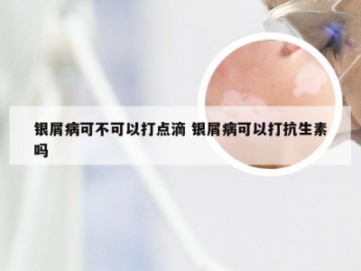 银屑病可不可以打点滴 银屑病可以打抗生素吗