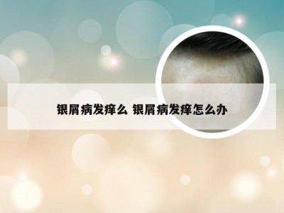 银屑病发痒么 银屑病发痒怎么办