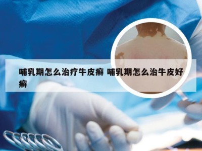 哺乳期怎么治疗牛皮癣 哺乳期怎么治牛皮好癣