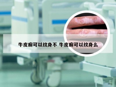 牛皮癣可以纹身不 牛皮癣可以纹身么