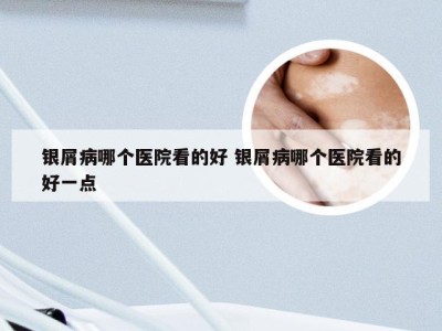 银屑病哪个医院看的好 银屑病哪个医院看的好一点