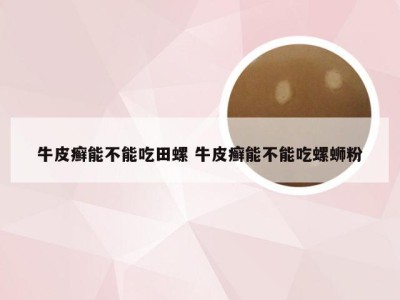 牛皮癣能不能吃田螺 牛皮癣能不能吃螺蛳粉