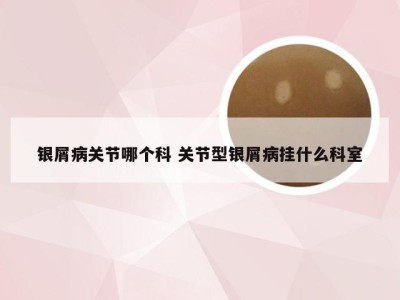 银屑病关节哪个科 关节型银屑病挂什么科室