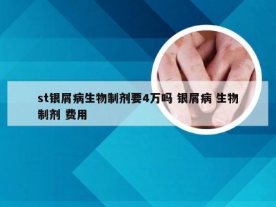 st银屑病生物制剂要4万吗 银屑病 生物制剂 费用