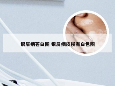 银屑病苍白圈 银屑病皮损有白色圈