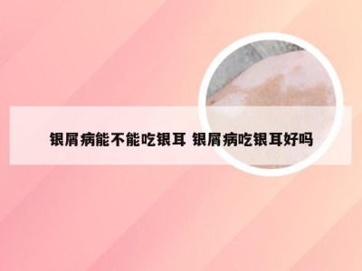 银屑病能不能吃银耳 银屑病吃银耳好吗
