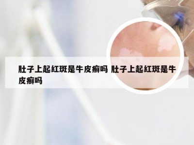 肚子上起红斑是牛皮癣吗 肚子上起红斑是牛皮癣吗