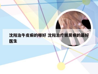 沈阳治牛皮癣的哪好 沈阳治疗银屑病的最好医生