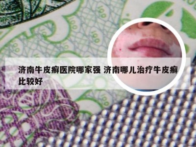 济南牛皮癣医院哪家强 济南哪儿治疗牛皮癣比较好