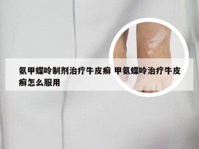 氨甲蝶呤制剂治疗牛皮癣 甲氨蝶呤治疗牛皮癣怎么服用