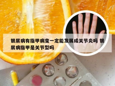 银屑病有指甲病变一定能发展成关节炎吗 银屑病指甲是关节型吗