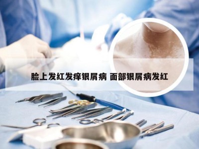 脸上发红发痒银屑病 面部银屑病发红