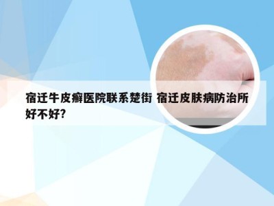宿迁牛皮癣医院联系楚街 宿迁皮肤病防治所好不好?