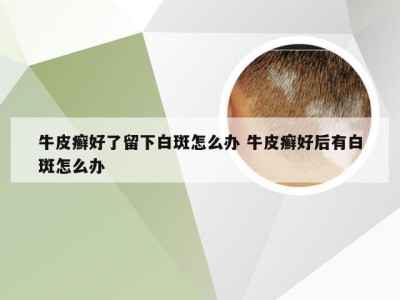 牛皮癣好了留下白斑怎么办 牛皮癣好后有白斑怎么办