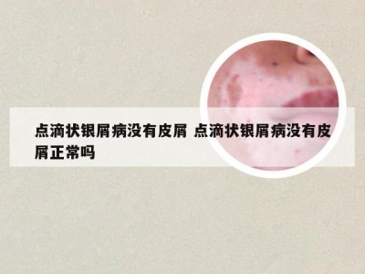 点滴状银屑病没有皮屑 点滴状银屑病没有皮屑正常吗