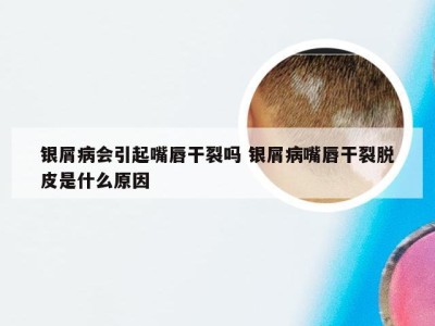 银屑病会引起嘴唇干裂吗 银屑病嘴唇干裂脱皮是什么原因