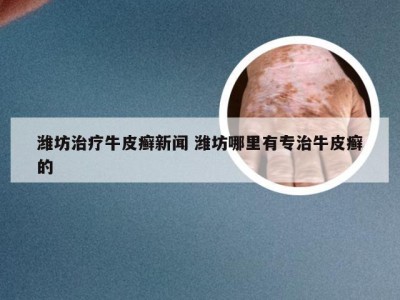 潍坊治疗牛皮癣新闻 潍坊哪里有专治牛皮癣的