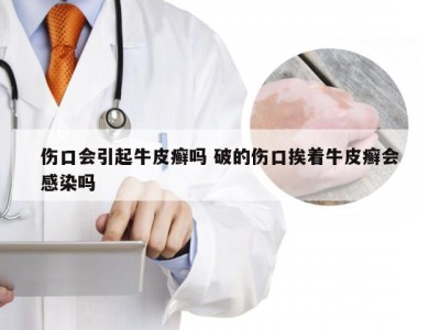 伤口会引起牛皮癣吗 破的伤口挨着牛皮癣会感染吗