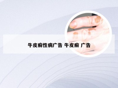 牛皮癣性病广告 牛皮癣 广告
