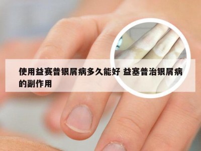 使用益赛普银屑病多久能好 益塞普治银屑病的副作用