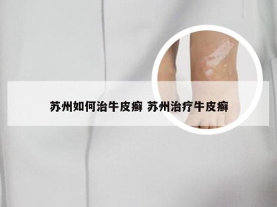 苏州如何治牛皮癣 苏州治疗牛皮癣