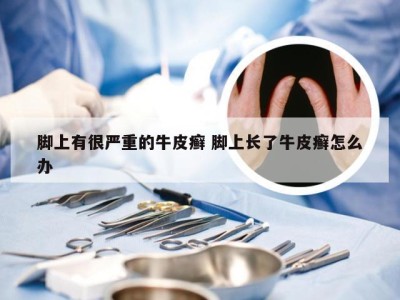 脚上有很严重的牛皮癣 脚上长了牛皮癣怎么办