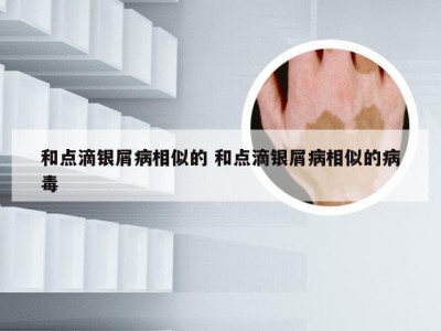 和点滴银屑病相似的 和点滴银屑病相似的病毒