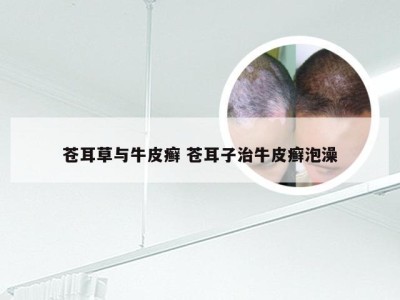 苍耳草与牛皮癣 苍耳子治牛皮癣泡澡