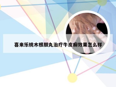 喜来乐桃木根胆丸治疗牛皮癣效果怎么样