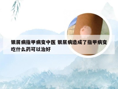 银屑病指甲病变中医 银屑病造成了指甲病变吃什么药可以治好