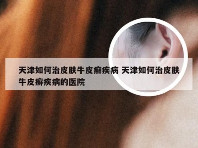 天津如何治皮肤牛皮癣疾病 天津如何治皮肤牛皮癣疾病的医院