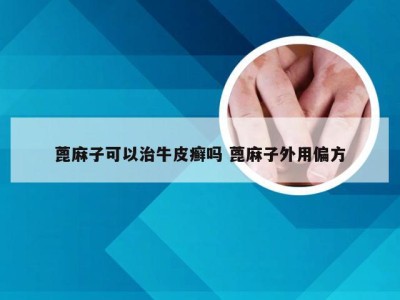 蓖麻子可以治牛皮癣吗 蓖麻子外用偏方